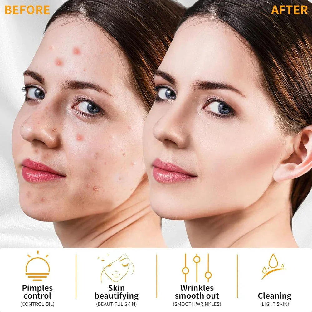 High Frequency Facial Wand